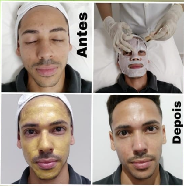 Antes e depois — tratamento facial completo com máscaras