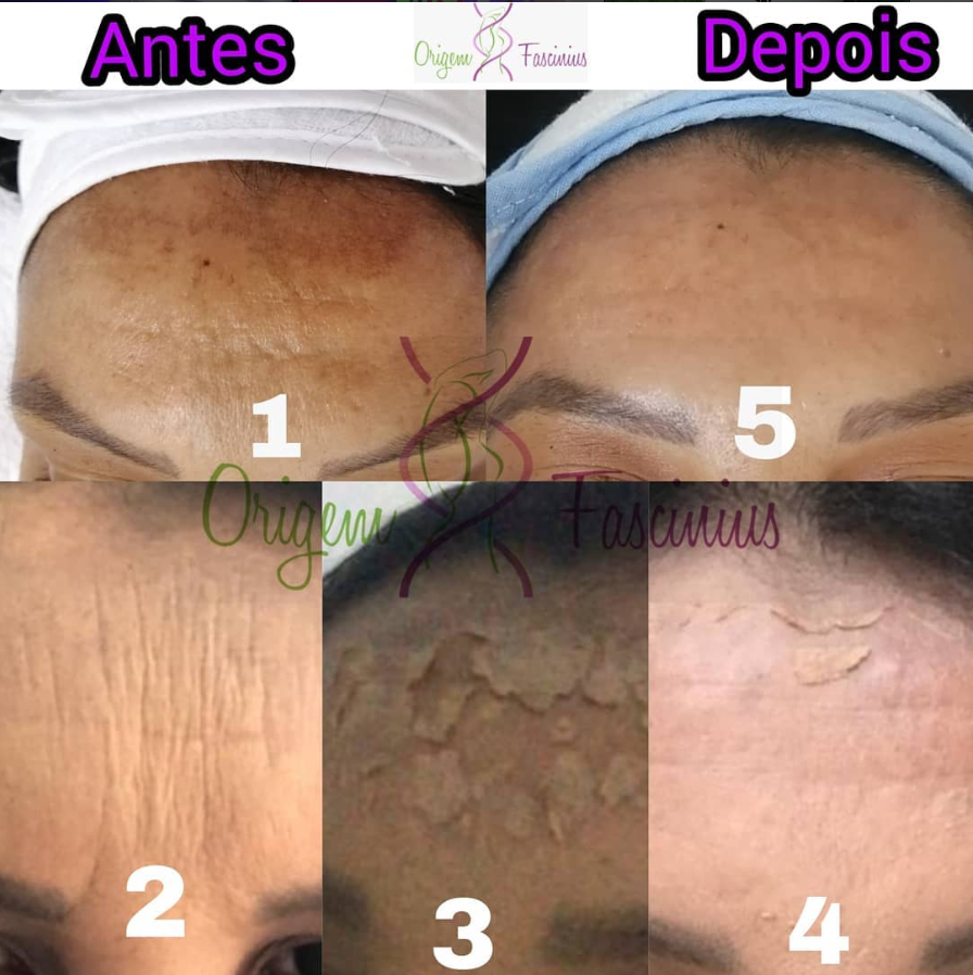 Antes e depois — redução de manchas e linhas na testa
