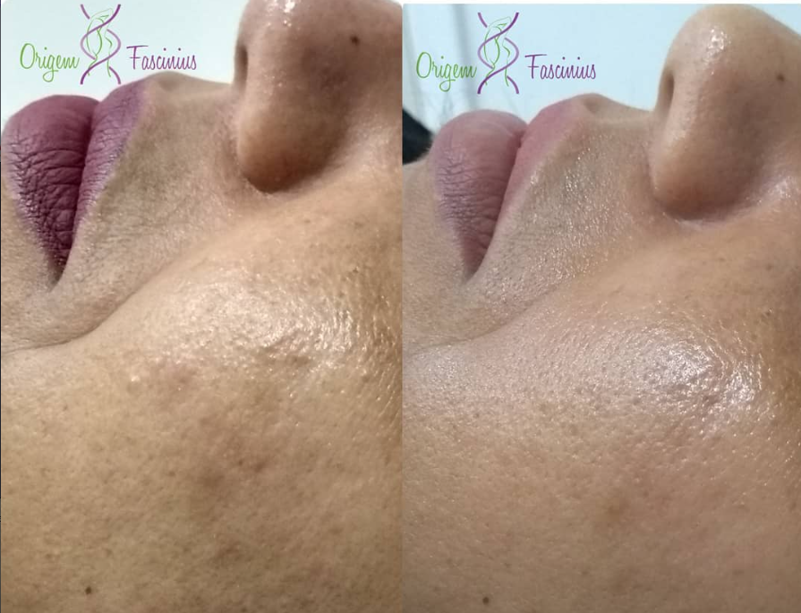 Antes e depois — textura e poros do rosto