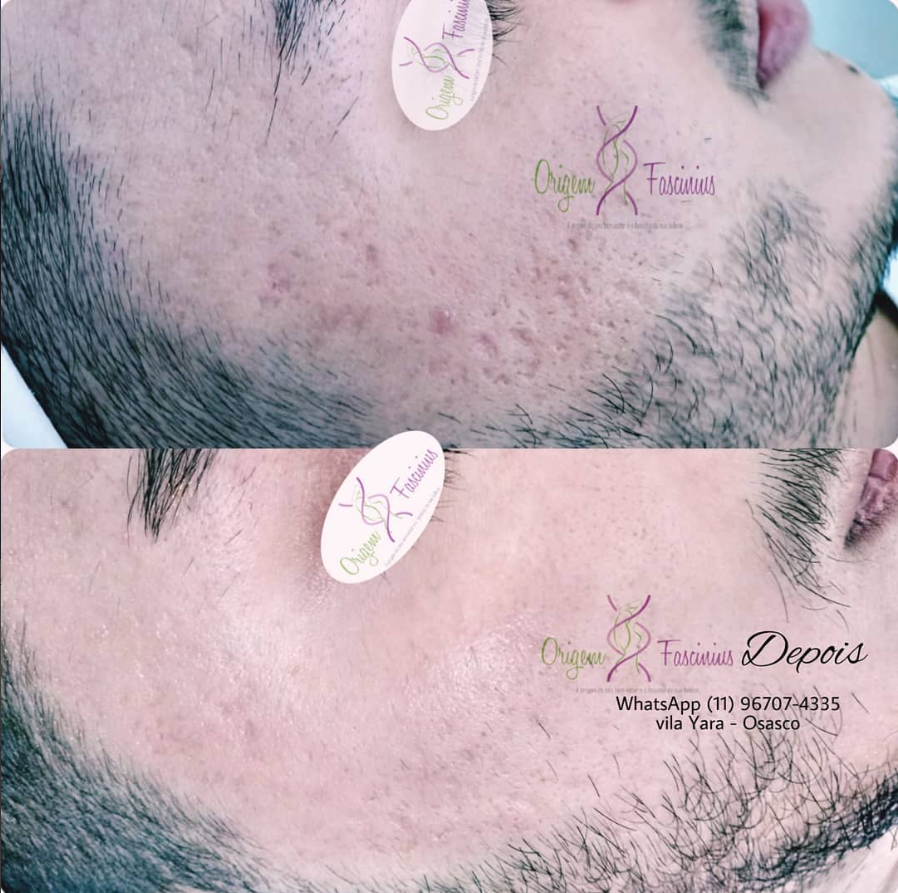 Antes e depois — tratamento de acne e cicatrizes