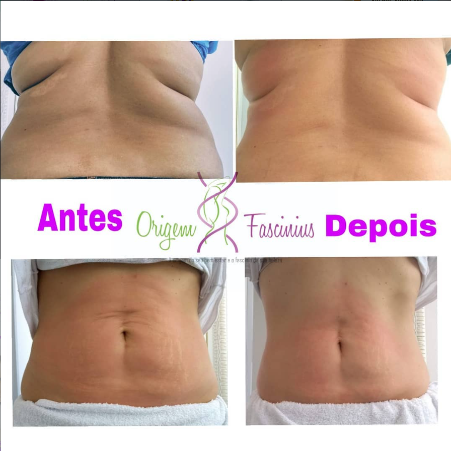 Antes e depois — tratamento corporal e gordura localizada
